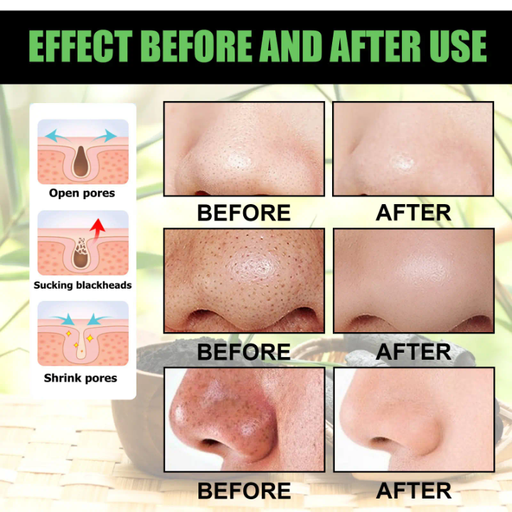 Charcoal Magic for Your Face Pack-1